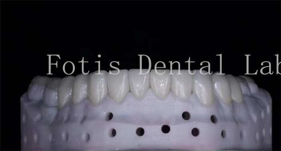 OEM ODM tahan noda Porselen yang terlihat alami veneers kekuatan tinggi