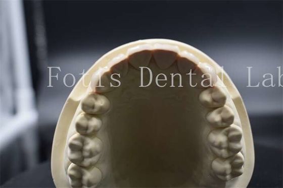 Kekuatan tinggi veneers gigi buatan Dentist Porselen veneers terlihat alami