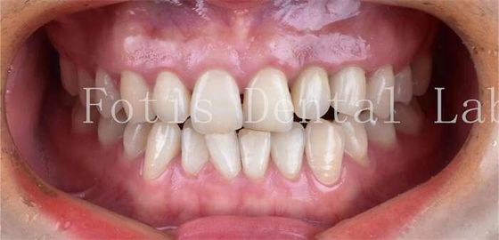 Kosmetik Kedokteran Gigi Dental Porselen veneers dengan ketahanan noda tinggi