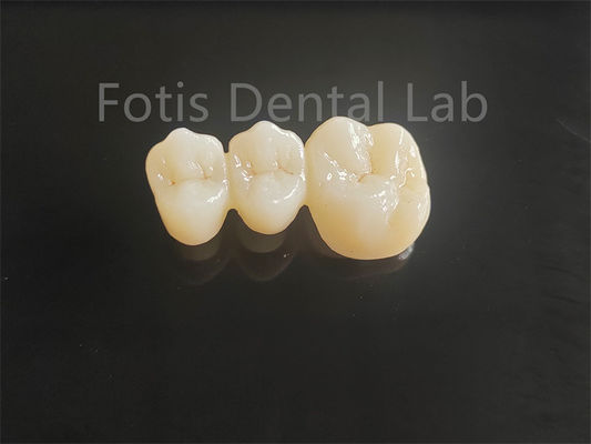 Zirconia Berlapis Porselen Kekuatan Tinggi Untuk Jembatan Gigi yang Bertahan Lama
