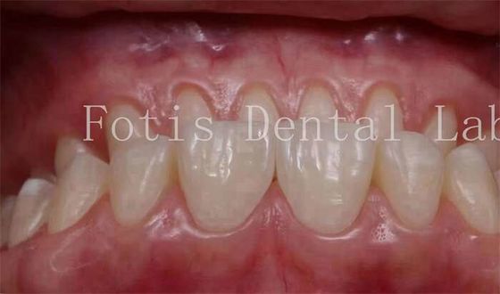 Beli Disesuaikan Penampilan Alam Snap On Veneers 0.3mm-0.5mm Ketebalan online manufacture