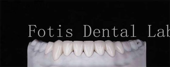 Ketahanan tinggi veneers gigi terlihat alami 0.3mm-0.5mm Ketebalan