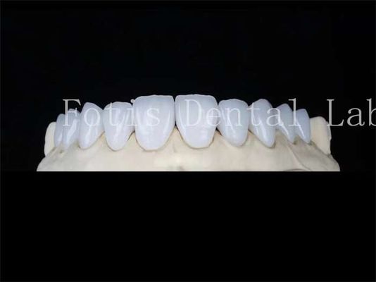 Disesuaikan Porselen Alam Veneers Lab Gigi Veneers tahan noda