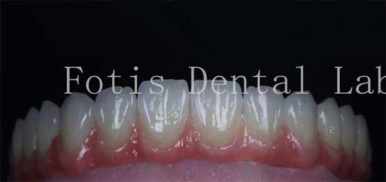 Permukaan halus Kosmetik Penutup gigi Porselen alami Veneers Disesuaikan