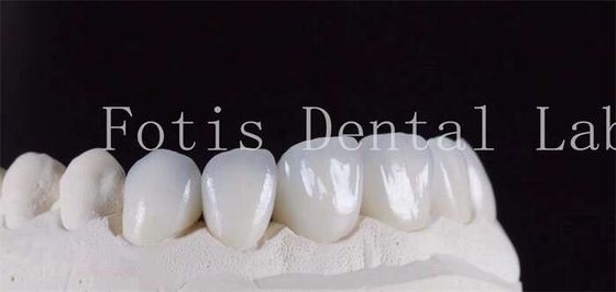 Ultra Strong Translucent Dental Laminate Veneers Warna alami