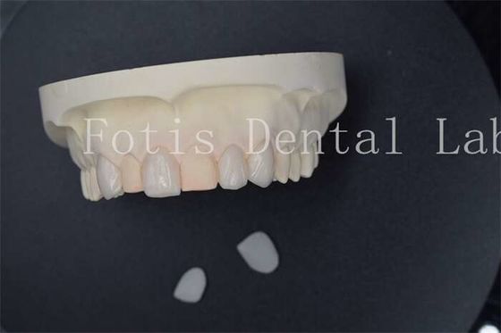 Custom Artificial Dental Laboratory Veneers Dengan Resistensi noda yang superior