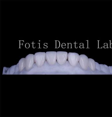 Tekstur Langsung Lancar Tutup Gigi Veneer Veneer Gigi Alami