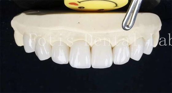 0.3-0.5mm Keramik Laminate Gigi False Teeth veneers Dengan Adhesive Bonding Cement