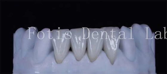 Ringan sintetis laminasi veneer gigi 0,3-0,5mm tebal terlihat indah