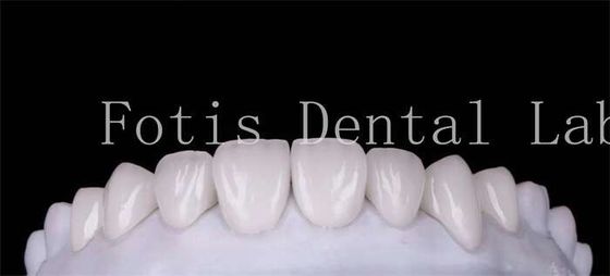 Polishing Finishing Cosmetic Teeth Veneer Cover Untuk Senyum Cantik