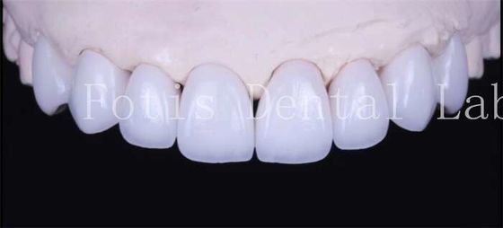 Cement Perekat Alam Putih Veneers Dengan Translucence Tinggi