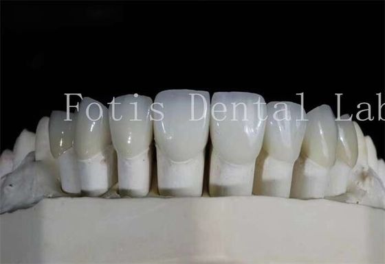 Laminasi Gigi yang Dipolikan Laminasi Gigi Translucence Tinggi Untuk Senyum yang terlihat alami