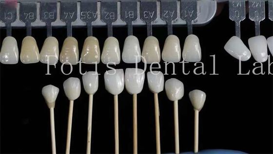 Disesuaikan veneer gigi alami overlay gigi palsu kekuatan tinggi