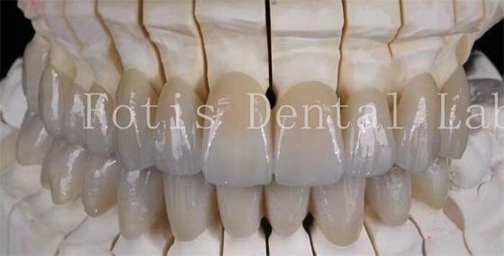Senyum yang terlihat alami Prosthetic Porcelain Laminate Veneers Permukaan halus