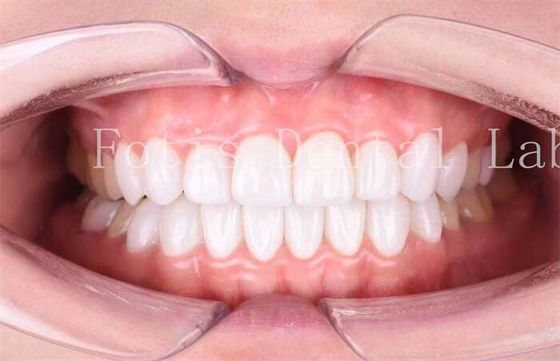 High Translucency Dental Laminate Veneers Durasi Panjang Lampu Polishing Finishing