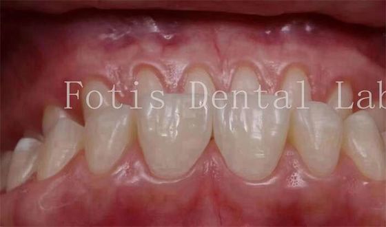 0.3-0.5mm Ketebalan Gigi Kosmetik Tutup Veneers Untuk Kedokteran Gigi Kosmetik