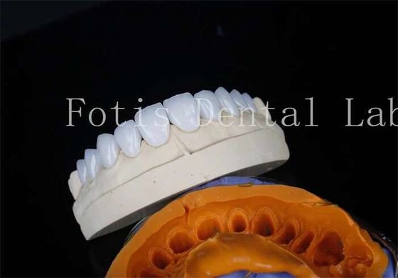 Porcelain Dental Lab Veneers Bonding Cement Untuk Restorasi Yang Lama