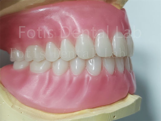 Gigi Ivoclar Full Acrylic Prosthesis Gampang Untuk Membersihkan Ketahanan Tinggi