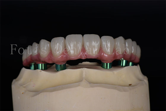 Titanium/Zirconia tahan lama Semua pada 4/6 Implan Perbaikan mudah Tingkat keberhasilan tinggi