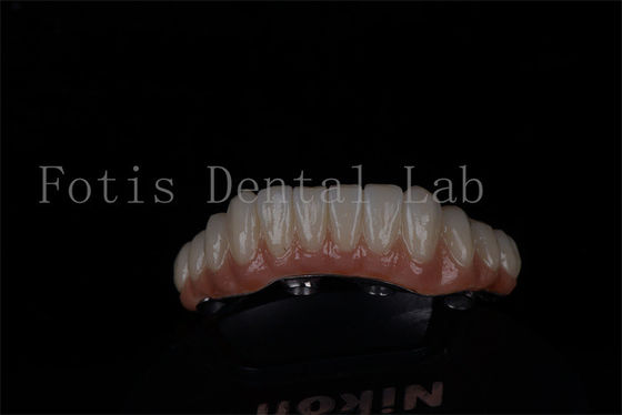 Restorasi mulut penuh semua pada 4 dan semua pada 6 Titanium atau Zirconia tingkat keberhasilan yang tinggi
