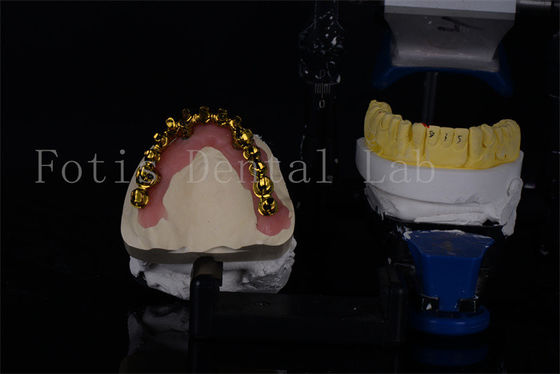 Harga terjangkau Titanium / Zirconia All On 4 Implan Gigi Untuk Senyum yang terlihat alami