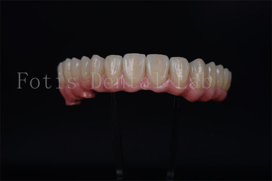 Full Arch Implant Bridge All On 4 All On 6 Untuk Restorasi Gigi Lengkap