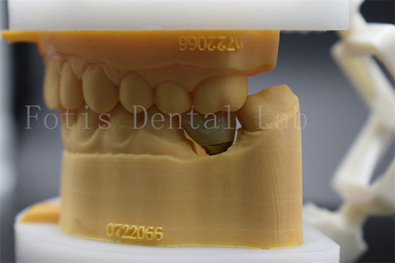 Long Lasting Polished Dental Lab Crown Precision Fit Kenyamanan Untuk Pasien