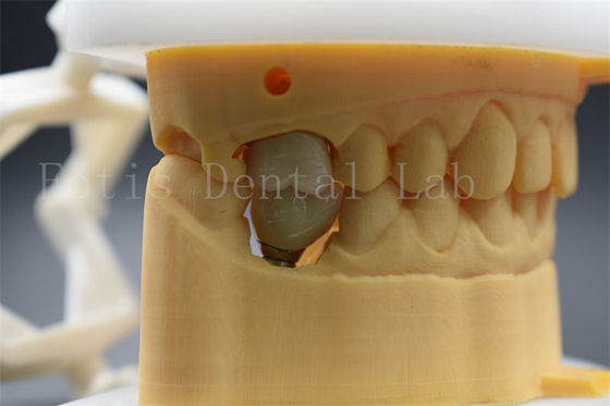 Dental Implant Abutment Customisable Mahkota Nyaman Untuk Pasien