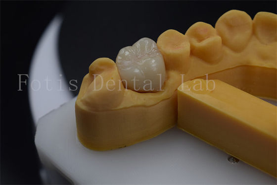 Titanium / PFM Denture Crown Disesuaikan Zirconia Implant Crown awet