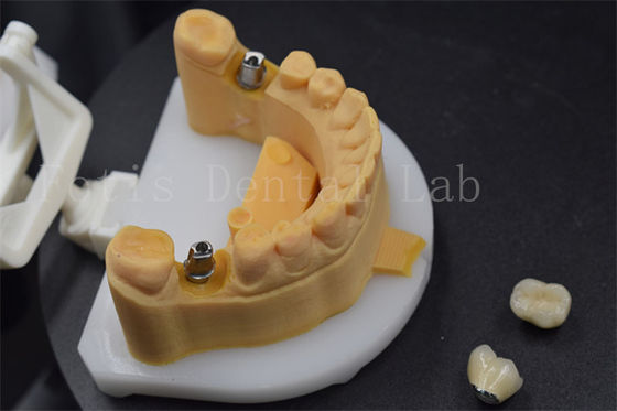 Mudah Untuk Menempatkan Zirconia Gelang Gelang Titanium Gelang Untuk Gelang Disesuaikan