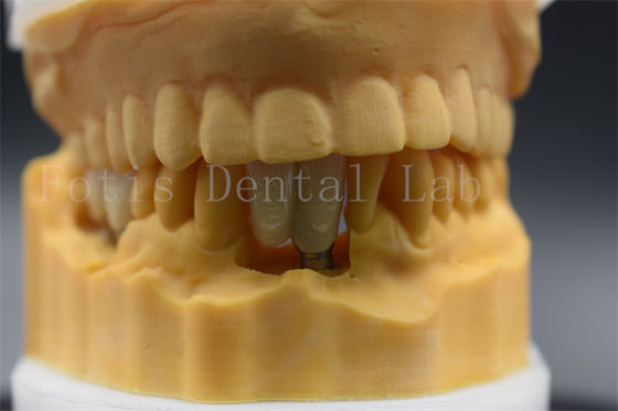 Dental Implant Custom Made Crown Precision Cocok untuk Gigi yang Hilang