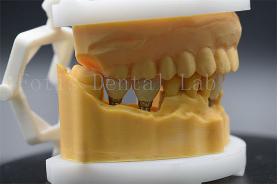 Titanium Precision Dental Crown Untuk Implan Gigi Mudah Di Bersihkan Dan Dipertahankan