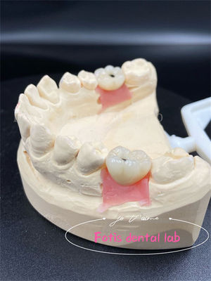 Titanium/Ziconia/PFM Dental Laboratory Crown
