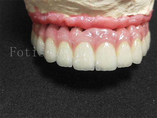 Titanium / Zirconia Implant Crown Polished Finish Krona Gigi Buatan