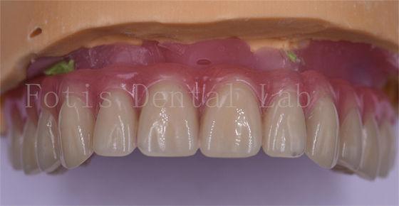 Kemewahan Pasien Mahkota Gigi Custom Titanium/Zirconia/PFM Implant Crown