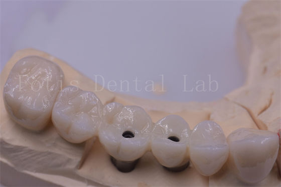 Titanium / Zirconia Dental Crown Perak Dipoli Untuk Gigi Yang Hilang
