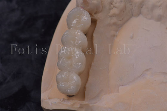 Precision Fit Zirconia Implantasi Mahkota Gigi PFM Mahkota Mudah Dibersihkan