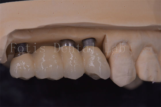 Titanium / Zirconia / PFM Memulihkan Gigi yang Hilang
