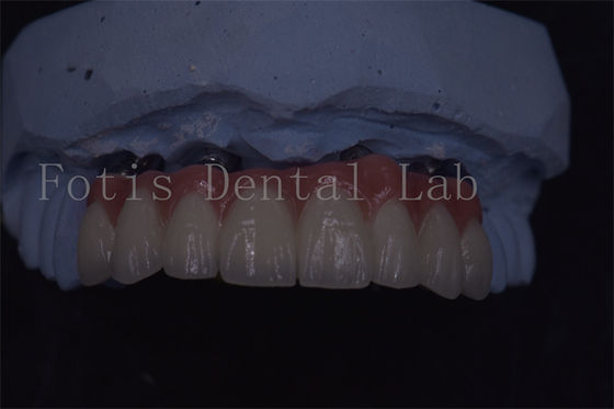 Mahkota Implantasi Gigi yang Dibuat dengan Precision Untuk Umur Panjang dan Kenyamanan