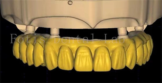 Desain Mahkota Gigi OEM Menggunakan Teknologi Pemindaian Lan Percetakan 3D Lanjutan