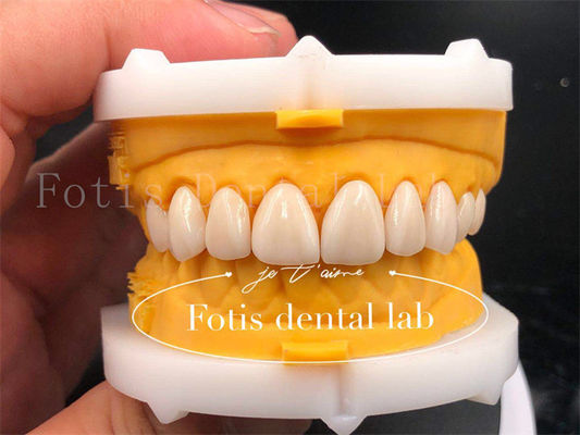 Cepat Dan Efisien Digital Dental Mahkota Ukuran kustomisasi Dental Implant Mahkota