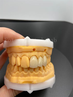 Precision Fit Digital Crowns Implant Dentrues Dengan Kompatibilitas Mode Transmisi Email