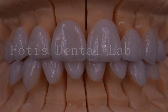 FDA/ISO/CE Sertifikasi Digital Crown Teeth Crown buatan Ukuran apapun