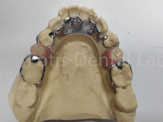 Dental Prothesis yang nyaman untuk gigi yang hilang