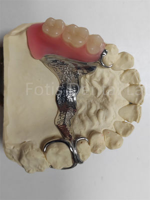 Dental parsial yang tahan bau yang bisa dilepas dan bisa disesuaikan dengan baik
