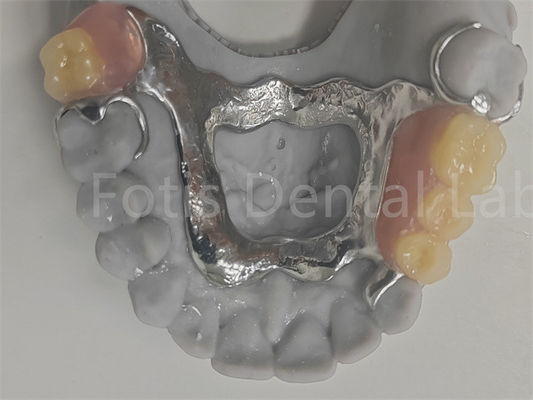 FDA Mudah untuk membersihkan removable sebagian gigi palsu kompatibel dengan gigi alami