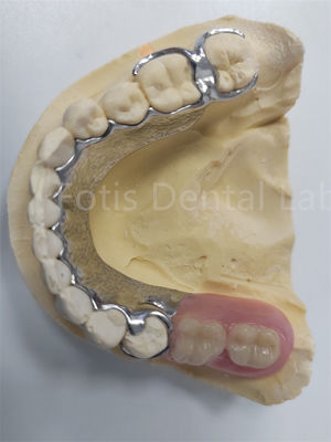 Ganti Gigi yang Hilang Dental Prothesis Bagian Yang Bisa Dihapus Desain Fleksibel