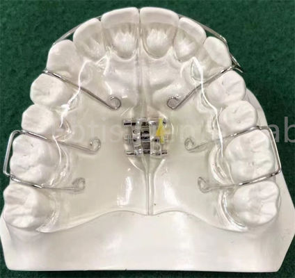 Peralatan Ortodontik State-of-the-Art Mengembang Retainer Disesuaikan