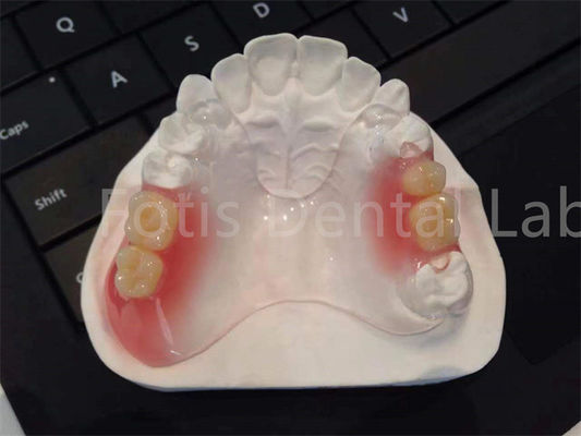 Fleksibel TCS Valplast Peralatan Gigi Desain yang Nyaman