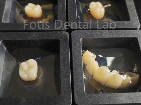 Restorasi Gigi Zirconia Karat Patah
